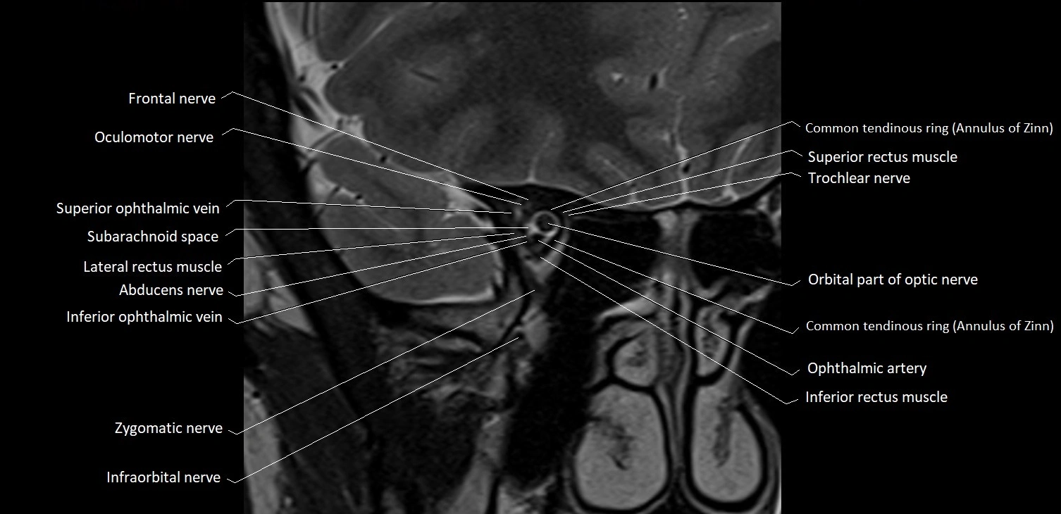 MRI Orbit coronal cross sectional anatomy image 14.webp